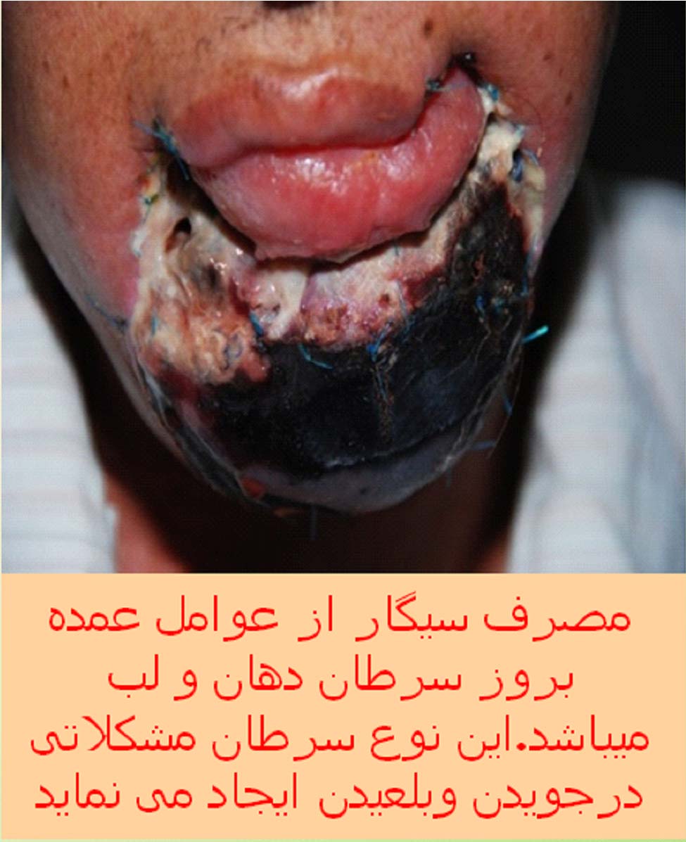 Iran 2009 Health Effects Mouth - mouth cancer, gross, lived experience